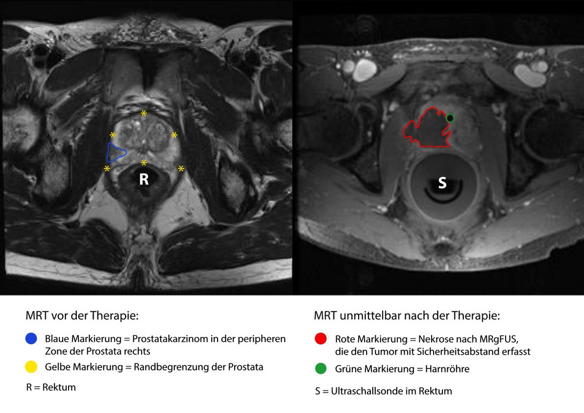 Beispiel eines erfolgreich mit MRgFUS behandelten Prostatakarzinoms